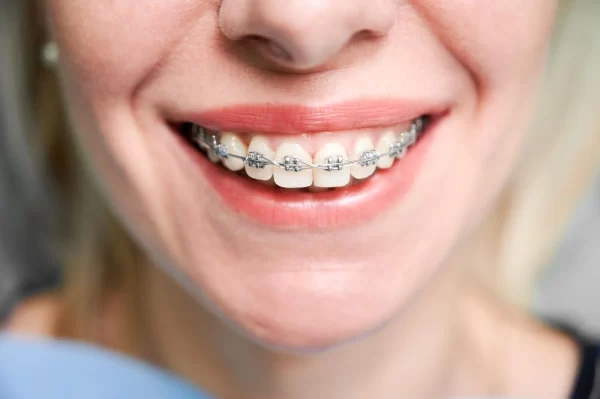 how to straighten teeth naturally at home