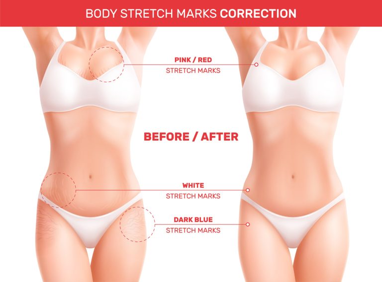 how to remove stretch marks permanently