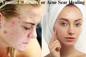 Before and after results of Vitamin E for fading acne scars naturally