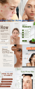 Infographic showing 5 benefits of Vitamin E for acne-prone skin, including healing scars and reducing inflammation